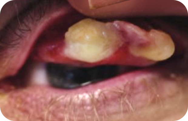 Ligneous conjunctivitis caused by congenital plasminogen deficiency type 1, manifesting as an eye lesion, prior to treatment with RYPLAZIM