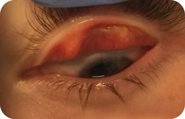 Ligneous conjunctivitis manifesting as a lesion under the upper eyelid