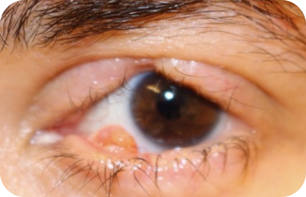 Ligneous conjunctivitis manifesting as a wart-like growth in the lower eyelid, accompanied by upper eyelid swelling