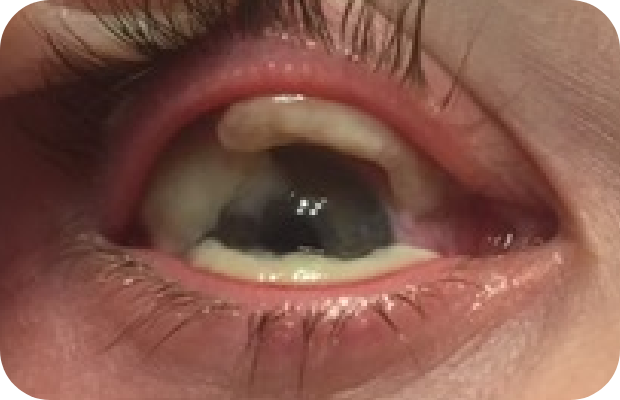 Ligneous conjunctivitis manifesting as large masses under upper and lower eyelids