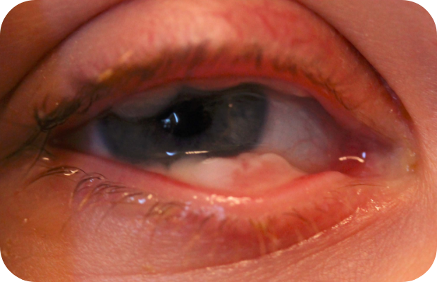 Ligneous conjunctivitis with lesion similar in appearance to conjunctival papilloma