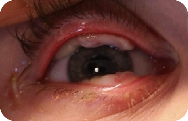 Ligneous conjunctivitis with lesions behind the upper and lower eyelids