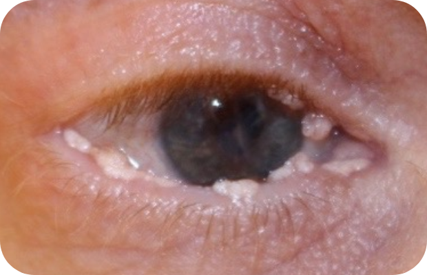 Ligneous conjunctivitis with multiple white, cauliflower-like lesions in upper and lower eyelids