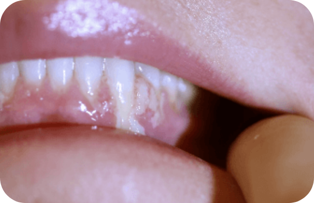 Ligneous gingivitis with gum swelling and lesions