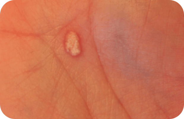 Skin lesions on palm of hand