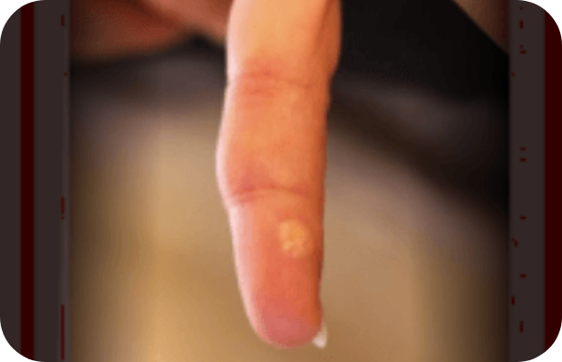 Skin lesions on thumb