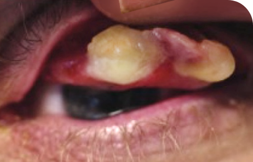 Ligneous conjunctivitis caused by congenital plasminogen deficiency type 1, manifesting as an eye lesion, prior to treatment with RYPLAZIM