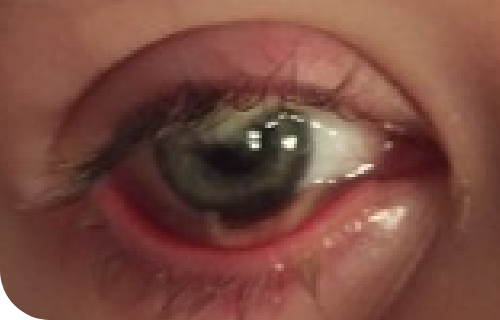 Ligneous conjunctivitis manifesting as watery, red eyes with lesions in lower eyelid
