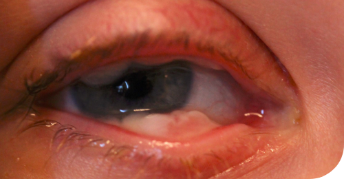 Ligneous conjunctivitis with lesion similar in appearance to conjunctival papilloma