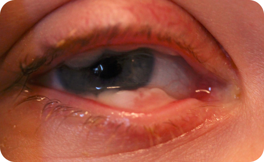 Ligneous conjunctivitis with lesion similar in appearance to conjunctival papilloma