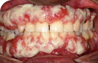 Ligneous gingivitis caused by congenital plasminogen deficiency type 1, manifesting as gum lesions
