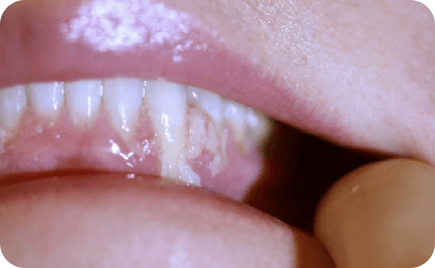 Ligneous gingivitis with gum swelling and lesions