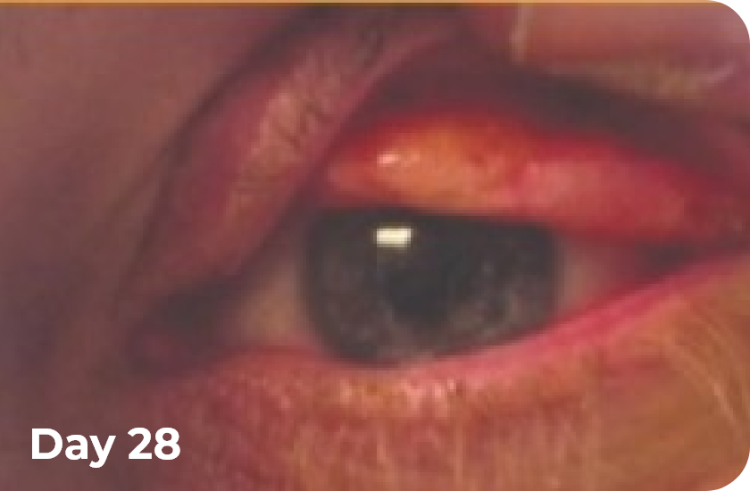 Photos of ligneous conjunctivitis before and after starting RYPLAZIM