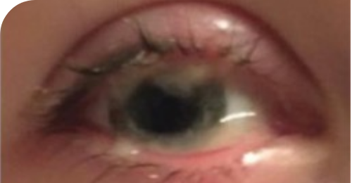 Pseudomembranous conjunctivitis caused by plasminogen deficiency type 1, with a watery and stringy appearance