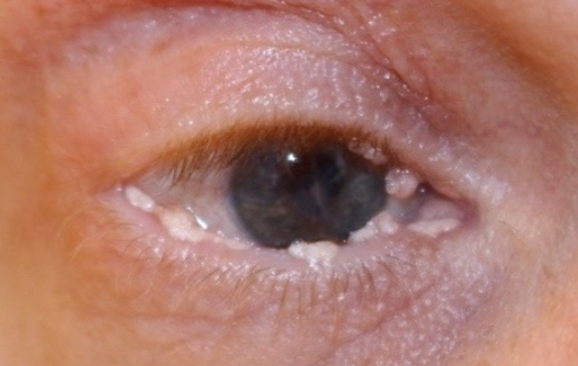 Ligneous conjunctivitis with multiple white, cauliflower-like lesions in upper and lower eyelids