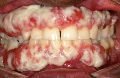 Ligneous gingivitis caused by congenital plasminogen deficiency type 1, manifesting as gum lesions