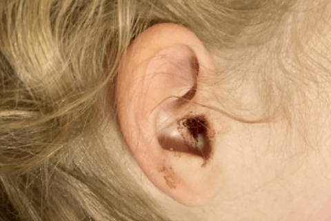 Otological lesions in plasminogen deficiency type 1 patient