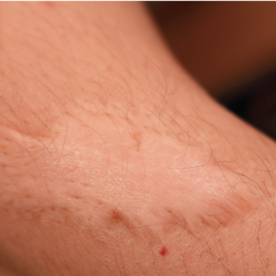 Skin lesions on arm