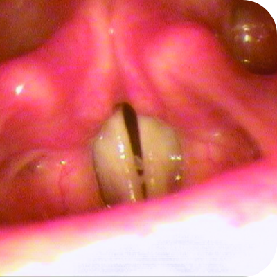 Respiratory tract lesions in plasminogen deficiency type 1 patient