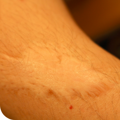 Skin lesions on arm